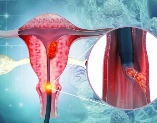 What is cervical cancer