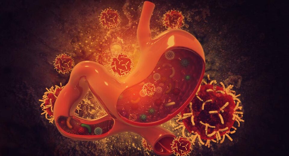 Stomach cancer in Singapore