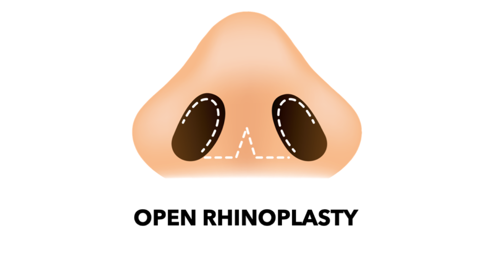 Open Rhinoplasty
