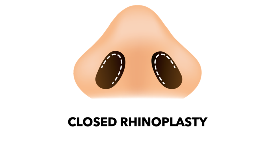 Closed Rhinoplasty