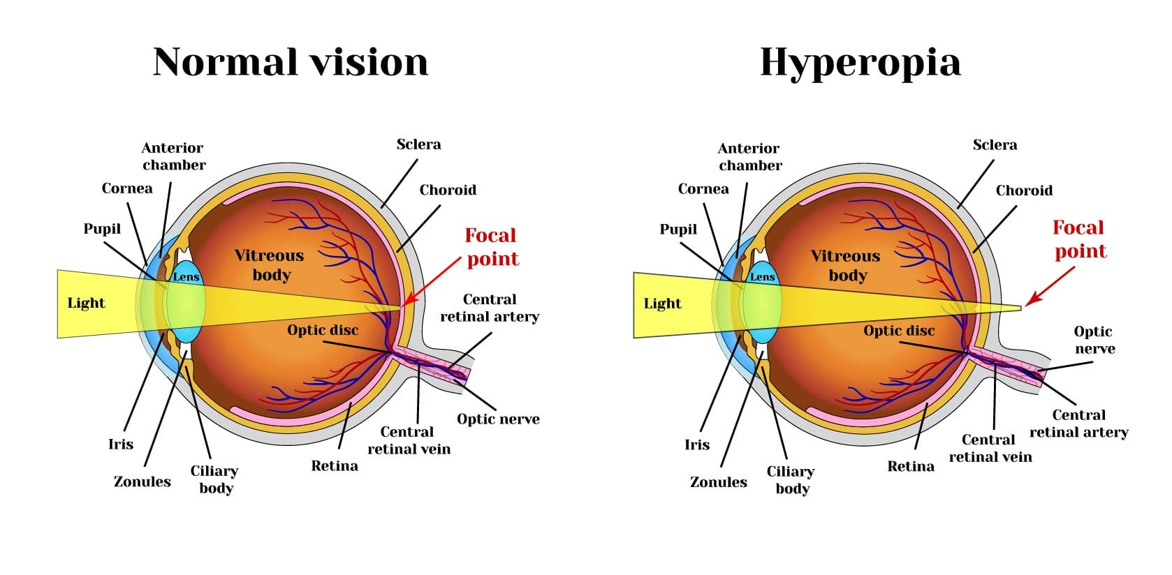 Hyperopiuqa Hyperopia - Health365