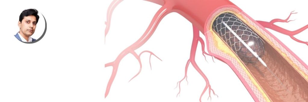 Coronary-Artery-Disease-Key-Visual