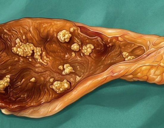 Gallbladder-Polyps-1