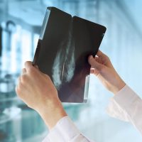 Mammogram Screening In Malaysia 马来西亚乳癌筛查